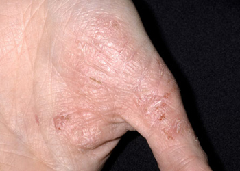 Eczema Treatment