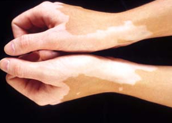 Leucoderma Treatment