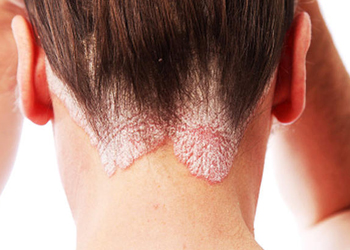 Psoriasis Treatment