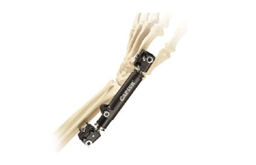 Alumium Dynamic Wrist Fixator, Certification : ISO, CE, FDA Certification