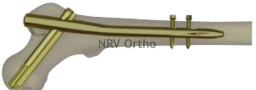 STAINLESS STEEL Long Proximal Femoral Nail, For Orthopedic Trauma Surgery