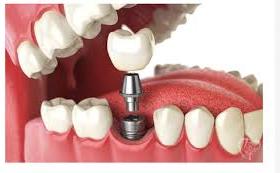 Teeth Replacement Services