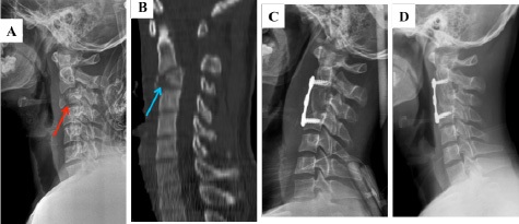 Anterior Cervical Corpectomy Spine Surgery Price In India