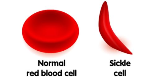 Sickle Cell Anemia Treatment In India