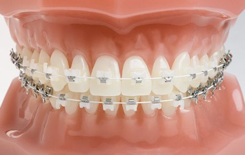 Ceramic Braces