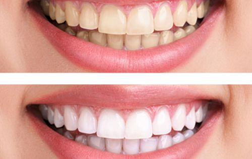 Tooth Whitening