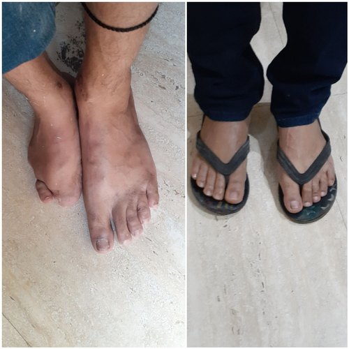 Rayon Rehab Silicone Foot Prosthesis