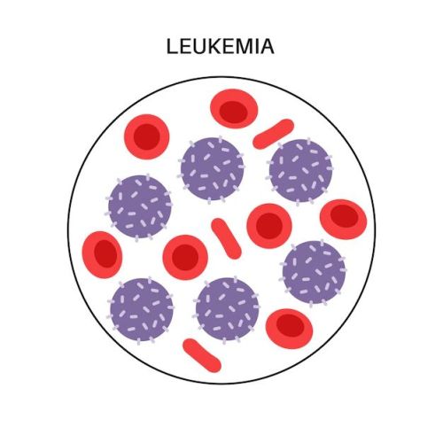 Leukemia Treatment