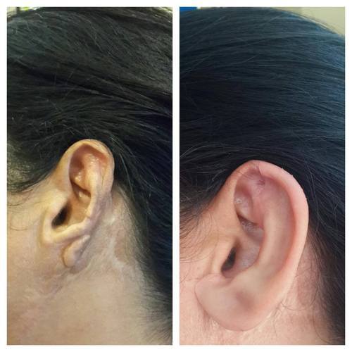 Silicone Ear Prosthesis