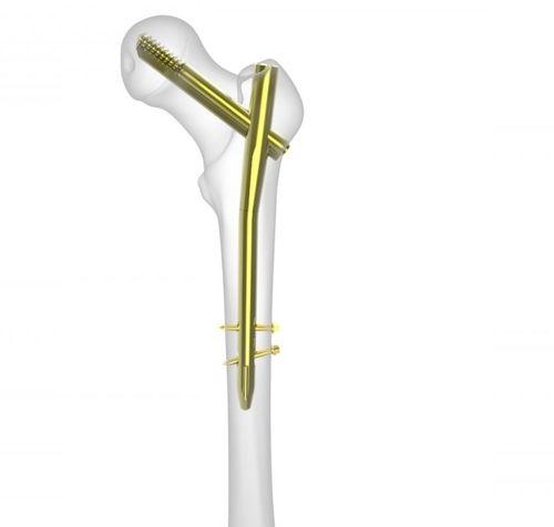 Stainless Steel Polished PFNA Nail, For Clinical, Hospital, Feature : Disposable, Easy To Use
