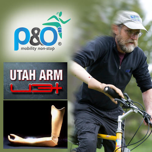 Arm Prostheses