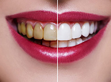 Teeth Whitening