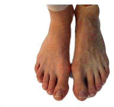 Silicone Partial Foot Prosthesis