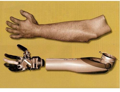 Prosthetic Hand