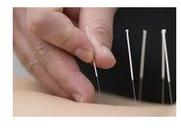 Acupuncture Needle