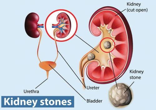 Lithotripsy System, For Clinical, Hospital