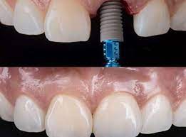 Dental Implant Surgery