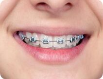 Metal Braces