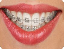 Self Ligating Braces