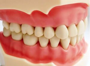 FRASACO AG-3 SCREW DRIVER TYPODONT JAW SET