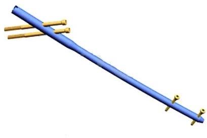 Recon Nail, Length : 320 To 440 Mm