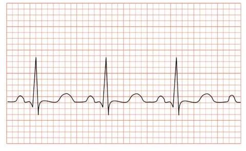 ECG Chart Paper, For Hospital