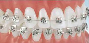 Self Ligating Brackets