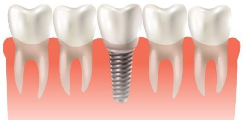 Dental Implants In India