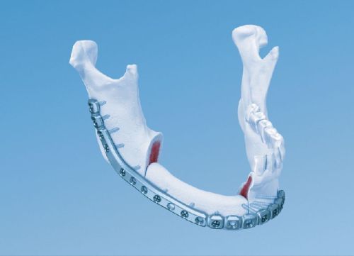 Mandible Implants