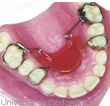 Upper Molars