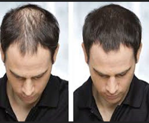 Hair Problem Treatment