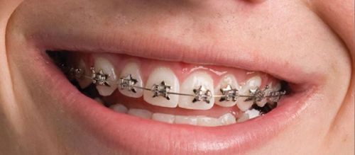 Orthodontic Treatment