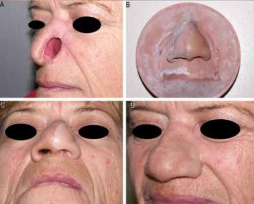 Plain Silicone Nose Prosthesis Osseointegrated Customized