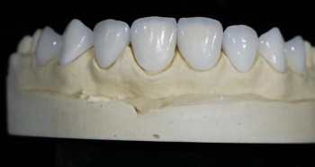 Zirconia Crowns