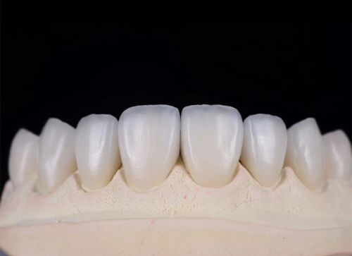 Partial Denture Chinese Dental Lab Outsourcing Services