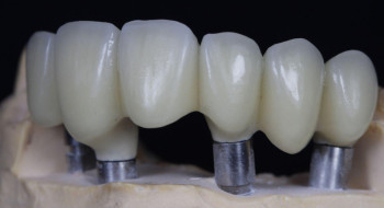 Zirconia Dental Crown