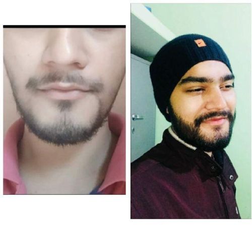 Moustache Hair Transplant