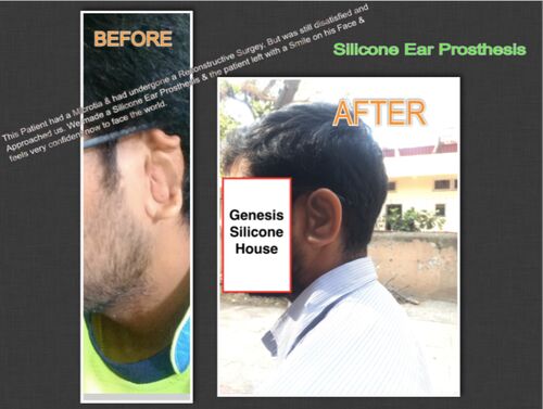 Silicone Ear Prosthesis