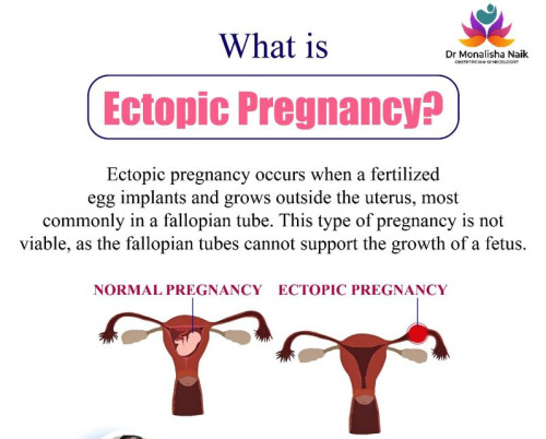 What Is Ectopic Pregnancy | High-risk Obstetrics Specialist In Bhubaneswar | Dr. Monalisha Naik