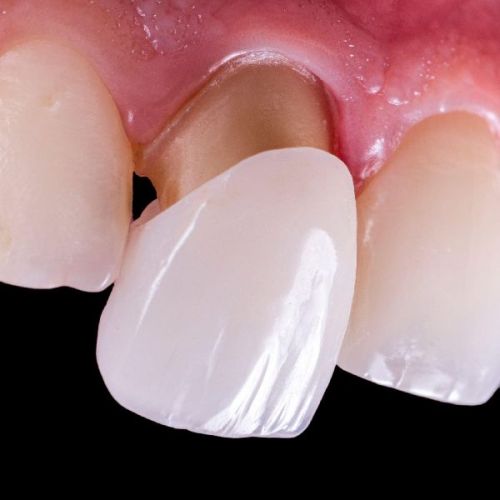 Dental Veneers