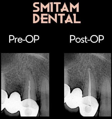 Re-Root Canal Treatment