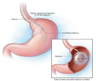 Intragastric Balloon Insertion