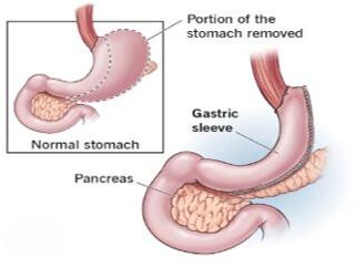 Sleeve Gastrectomy