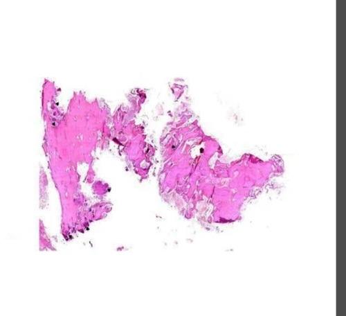 Actinomycotic Osteomyelitis Pathology Glass Slide, Size : Multisizes