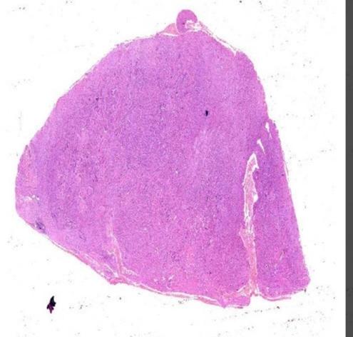 Transparent Amyloidosis Liver, Feature : Eco Friendly, Superior Quality