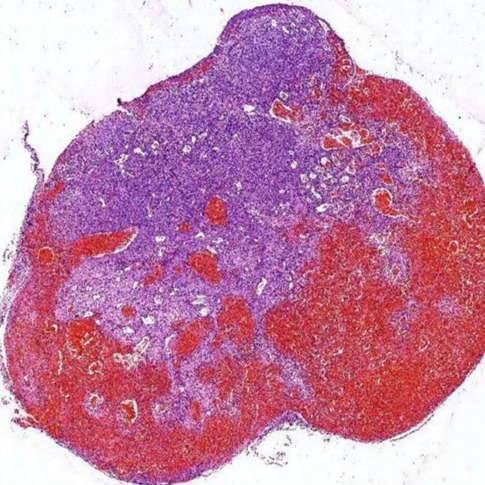 Transparent Capillary Hemangioma, For Clinical, Laboratory, Feature : Eco Friendly, Superior Quality