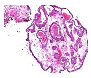 Cystitis Cystica Prepared Microscope Slide, For Clinical, Laboratory, Feature : Eco Friendly, Superior Quality