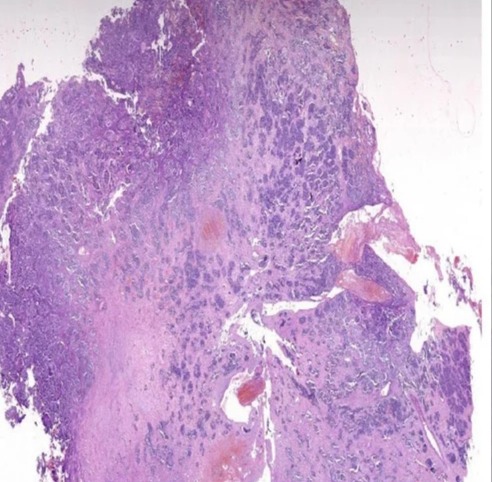 Plain Neuroblastoma Pathology Prepared Slide, For Clinical, Laboratory, Feature : Eco Friendly, Superior Quality