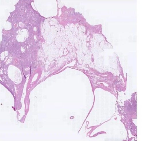 Transparent Rectangular Polycystic Kidney Disease Pathology Slide, For Clinical, Laboratory, Size : Standard