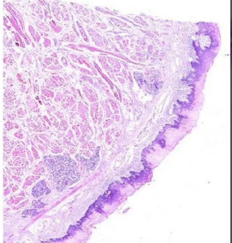 White Sponge Nevus Prepared Microscope Slide For Clinical, Laboratory